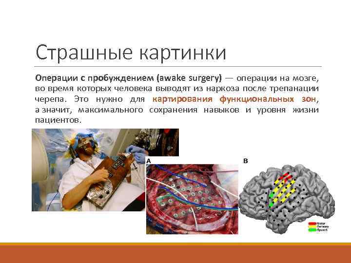 Страшные картинки Операции с пробуждением (awake surgery) — операции на мозге, во время которых