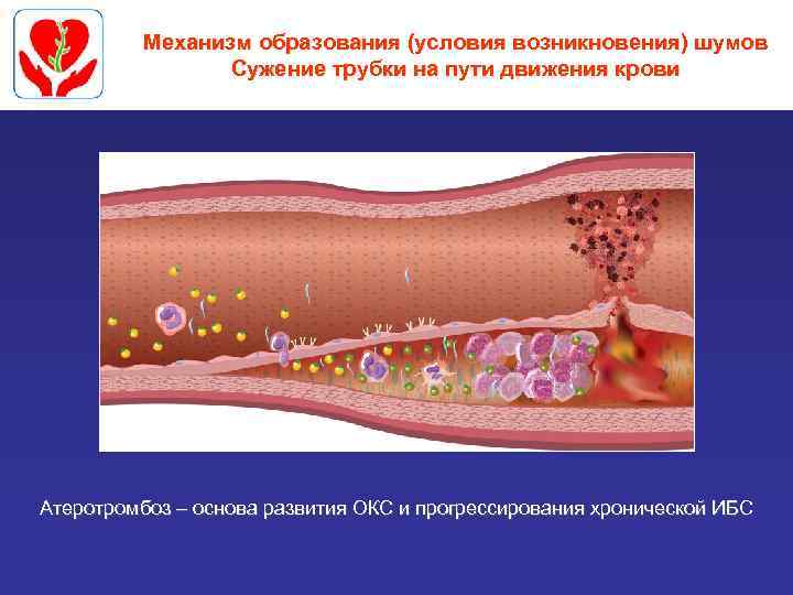 Механизм образования (условия возникновения) шумов Сужение трубки на пути движения крови Атеротромбоз – основа