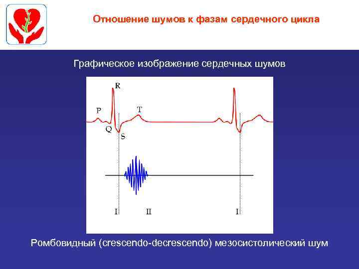 Отношение шумов к фазам сердечного цикла Графическое изображение сердечных шумов Ромбовидный (crescendo-decrescendo) мезосистолический шум