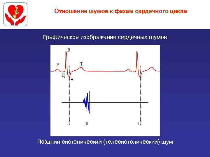 Отношение шумов к фазам сердечного цикла Графическое изображение сердечных шумов Поздний систолический (телесистолический) шум