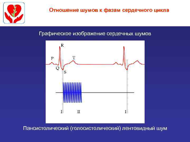 Отношение шумов к фазам сердечного цикла Графическое изображение сердечных шумов Пансистолический (голосистолический) лентовидный шум