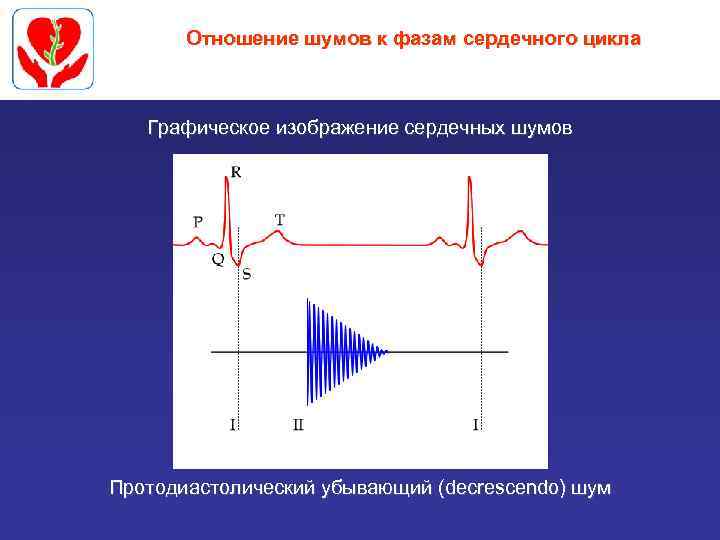 Отношение шумов к фазам сердечного цикла Графическое изображение сердечных шумов Протодиастолический убывающий (decrescendo) шум