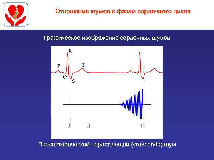 Отношение шумов к фазам сердечного цикла Графическое изображение сердечных шумов Пресистолический нарастающий (crescendo) шум
