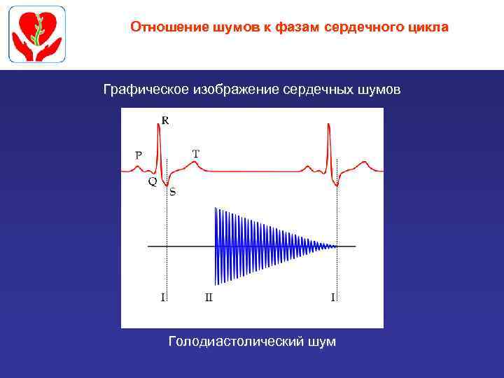 Отношение шумов к фазам сердечного цикла Графическое изображение сердечных шумов Голодиастолический шум 