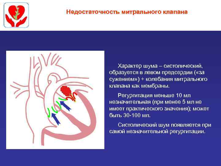 Недостаточность митрального клапана Характер шума – систолический, образуется в левом предсердии ( «за сужением»