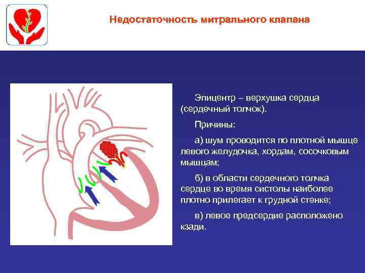 Недостаточность митрального клапана Эпицентр – верхушка сердца (сердечный толчок). Причины: а) шум проводится по