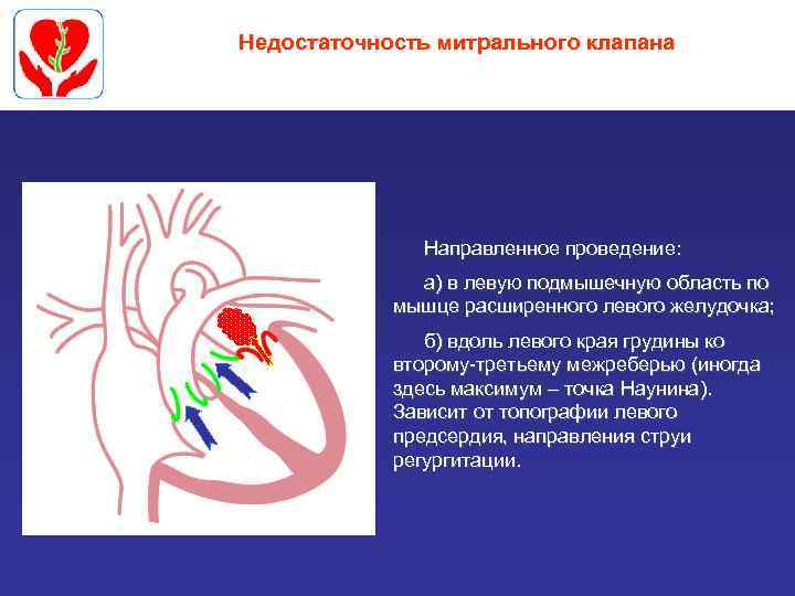 Недостаточность митрального клапана Направленное проведение: а) в левую подмышечную область по мышце расширенного левого