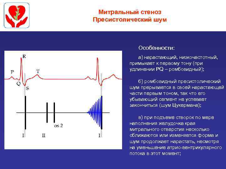 Митральный стеноз Пресистолический шум Особенности: а) нарастающий, низкочастотный, примыкает к первому тону (при удлинении