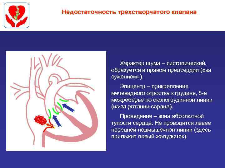 Недостаточность трехстворчатого клапана Характер шума – систолический, образуется в правом предсердии ( «за сужением»