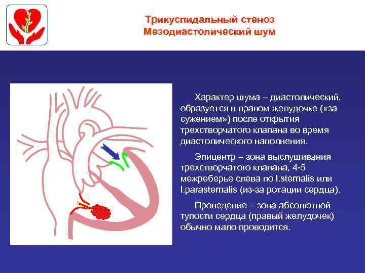Трикуспидальный стеноз Мезодиастолический шум Характер шума – диастолический, образуется в правом желудочке ( «за