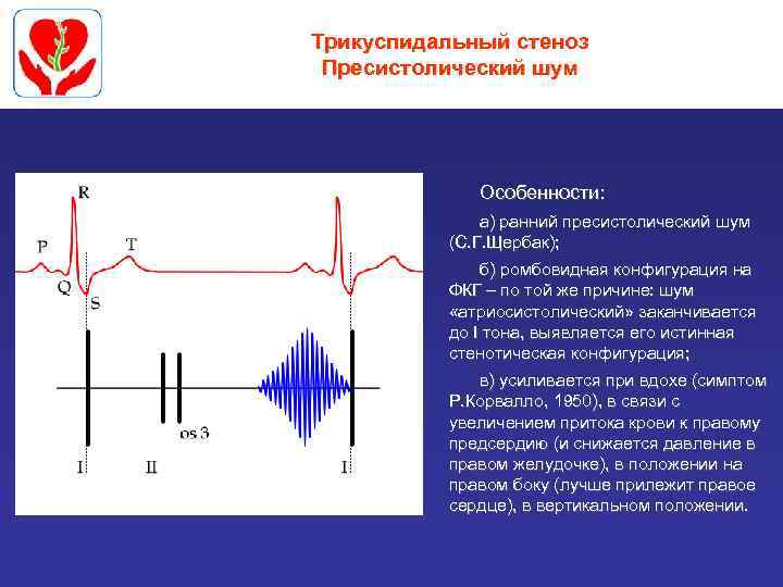 Трикуспидальный стеноз Пресистолический шум Особенности: а) ранний пресистолический шум (С. Г. Щербак); б) ромбовидная