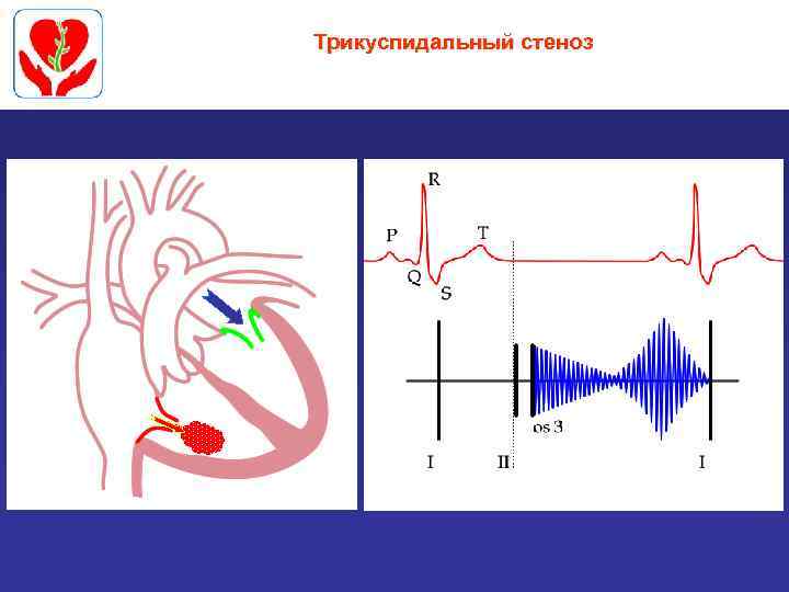 Трикуспидальный стеноз 