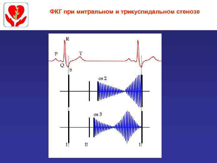 ФКГ при митральном и трикуспидальном стенозе 