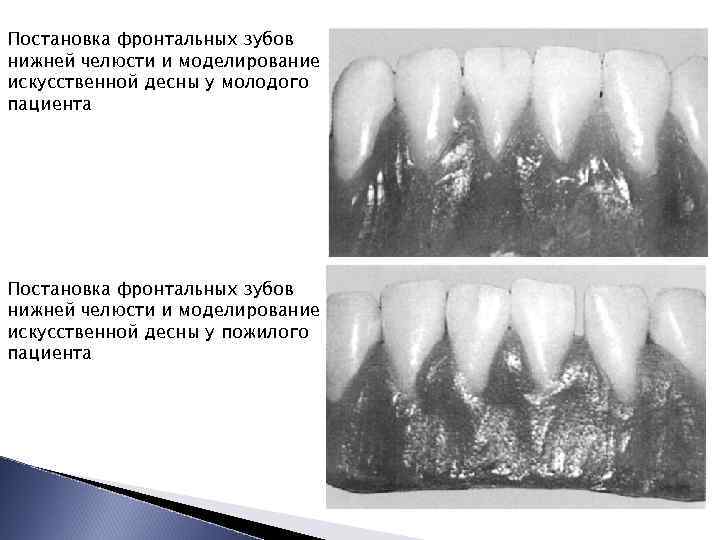 Постановка фронтальных зубов нижней челюсти и моделирование искусственной десны у молодого пациента Постановка фронтальных