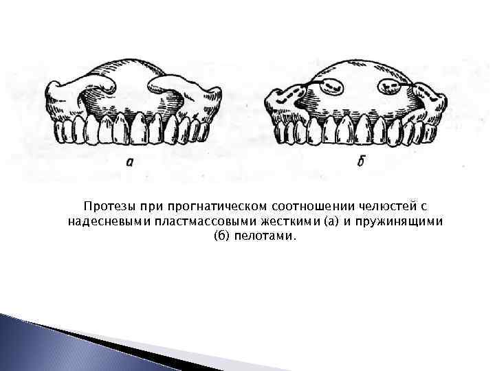 Постановка искусственных зубов по васильеву презентация