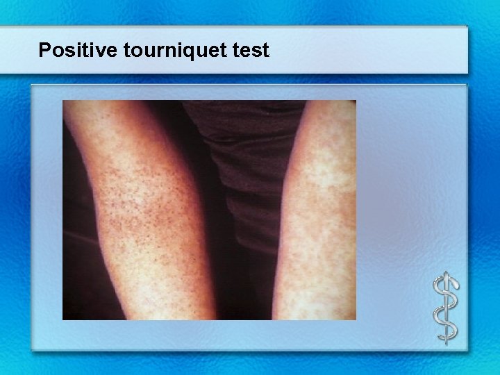 Positive tourniquet test 