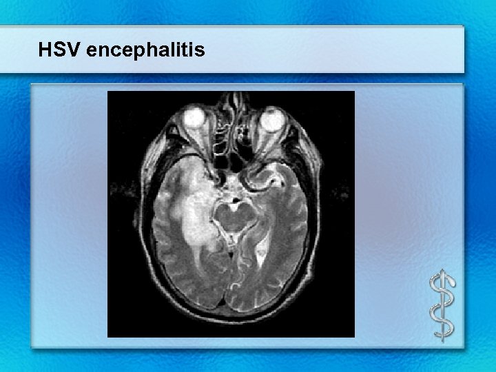 HSV encephalitis 