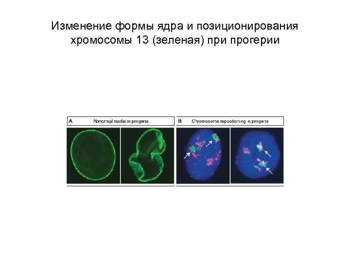 Изменение формы ядра и позиционирования хромосомы 13 (зеленая) при прогерии 