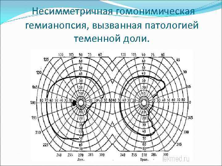  Несимметричная гомонимическая гемианопсия, вызванная патологией теменной доли. 