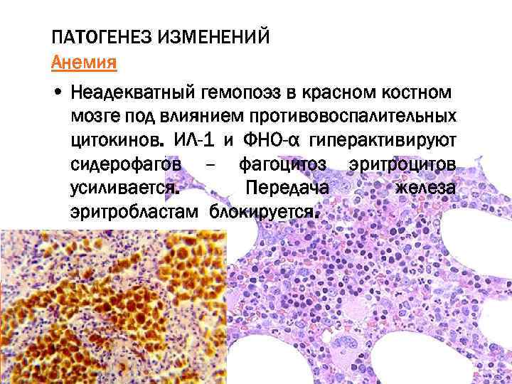 Пиоидный костный мозг. Пиоидный костный мозг препарат. Изменения красного костного мозга. Пиоидный костный мозг патанатомия. Пиоидный костный мозг при лейкозе.