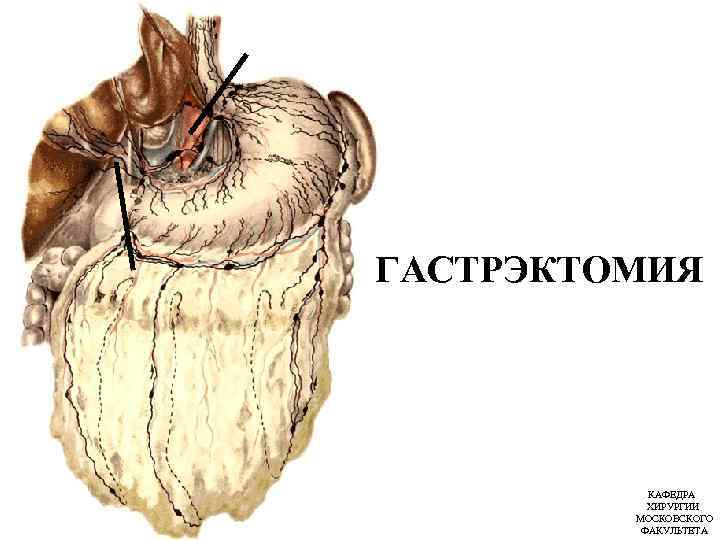 ГАСТРЭКТОМИЯ КАФЕДРА ХИРУРГИИ МОСКОВСКОГО ФАКУЛЬТЕТА 