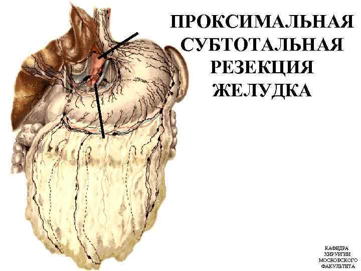 ПРОКСИМАЛЬНАЯ СУБТОТАЛЬНАЯ РЕЗЕКЦИЯ ЖЕЛУДКА КАФЕДРА ХИРУРГИИ МОСКОВСКОГО ФАКУЛЬТЕТА 