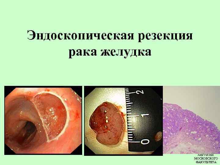 Эндоскопическая резекция рака желудка КАФЕДРА ХИРУРГИИ МОСКОВСКОГО ФАКУЛЬТЕТА 