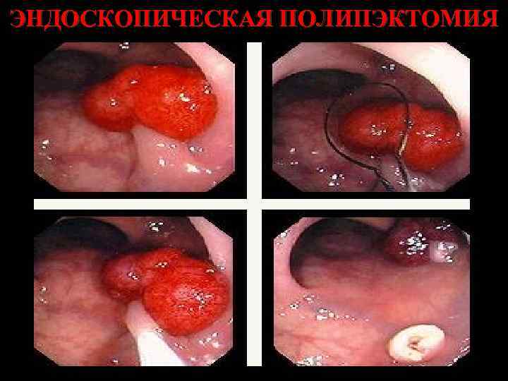 ЭНДОСКОПИЧЕСКАЯ ПОЛИПЭКТОМИЯ 