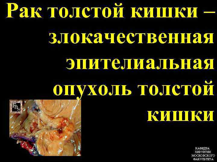 Рак толстой кишки – злокачественная эпителиальная опухоль толстой кишки КАФЕДРА ХИРУРГИИ МОСКОВСКОГО ФАКУЛЬТЕТА 