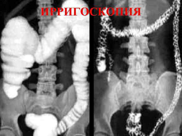 ИРРИГОСКОПИЯ КАФЕДРА ХИРУРГИИ МОСКОВСКОГО ФАКУЛЬТЕТА 