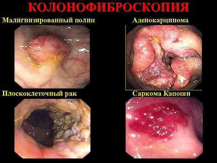 КОЛОНОФИБРОСКОПИЯ Малигнизированный полип Аденокарцинома Плоскоклеточный рак Саркома Капоши 