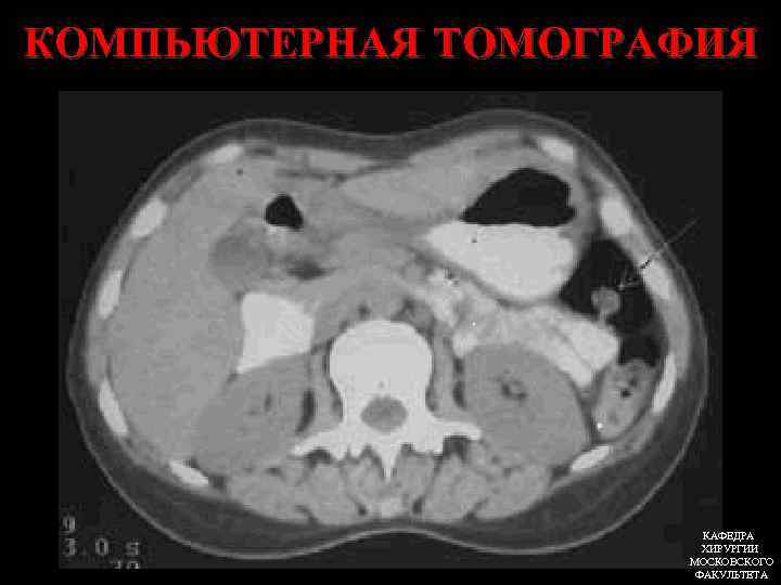 КОМПЬЮТЕРНАЯ ТОМОГРАФИЯ КАФЕДРА ХИРУРГИИ МОСКОВСКОГО ФАКУЛЬТЕТА 