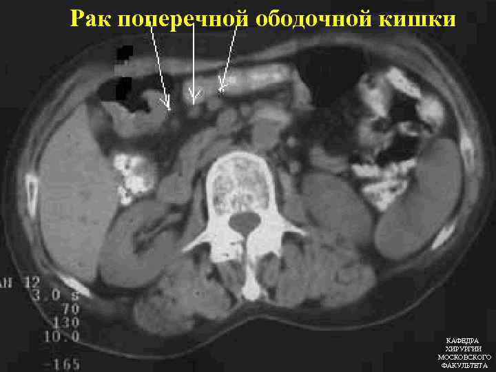 Рак поперечной ободочной кишки КАФЕДРА ХИРУРГИИ МОСКОВСКОГО ФАКУЛЬТЕТА 