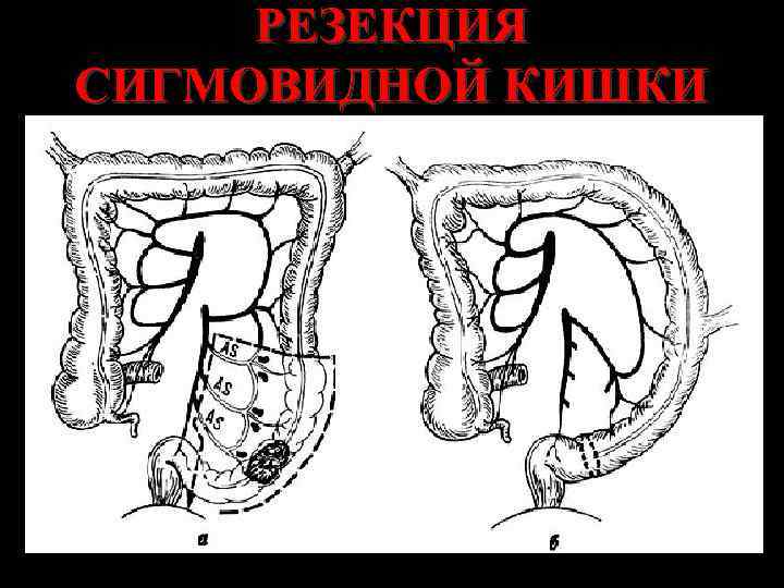 Рак толстой кишки хирургия презентация