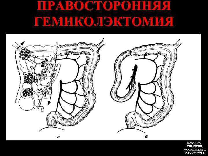 ПРАВОСТОРОННЯЯ ГЕМИКОЛЭКТОМИЯ КАФЕДРА ХИРУРГИИ МОСКОВСКОГО ФАКУЛЬТЕТА 