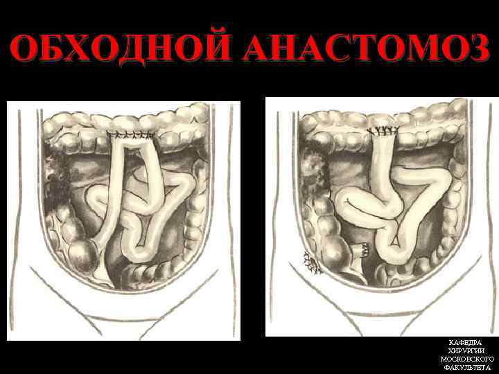 ОБХОДНОЙ АНАСТОМОЗ КАФЕДРА ХИРУРГИИ МОСКОВСКОГО ФАКУЛЬТЕТА 