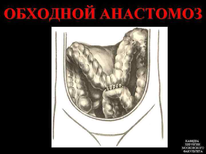 ОБХОДНОЙ АНАСТОМОЗ КАФЕДРА ХИРУРГИИ МОСКОВСКОГО ФАКУЛЬТЕТА 