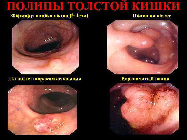 ПОЛИПЫ ТОЛСТОЙ КИШКИ Формирующийся полип (3 -4 мм) Полип на широком основании Полип на