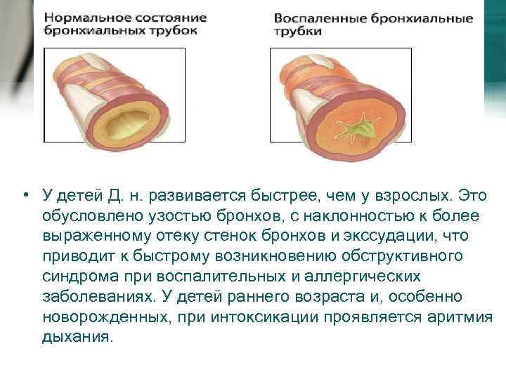  • У детей Д. н. развивается быстрее, чем у взрослых. Это обусловлено узостью