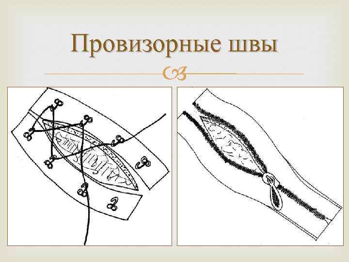 Провизорные швы 