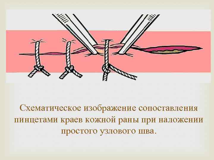  Схематическое изображение сопоставления пинцетами краев кожной раны при наложении простого узлового шва. 