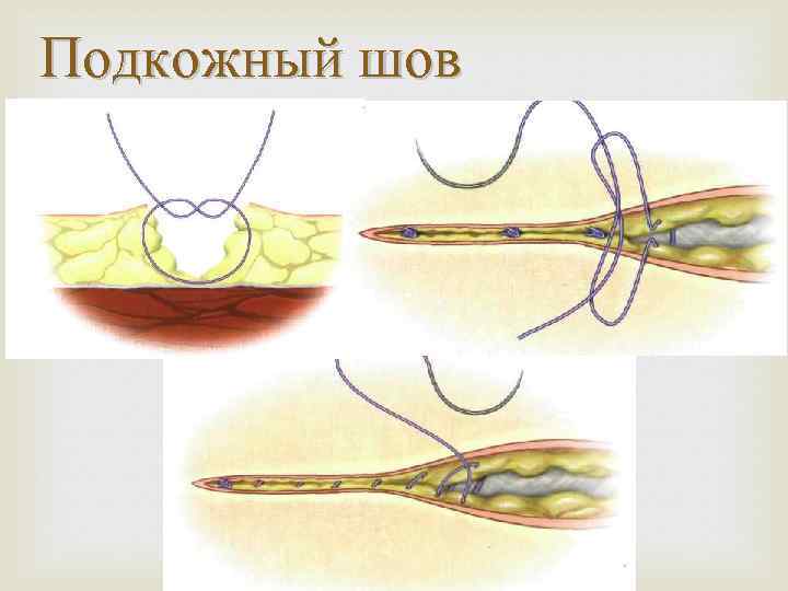 Подкожный шов 