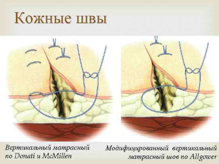 Кожные швы Вертикальный матрасный по Donati и Mc. Millen Модифицированный вертикальный матрасный шов по