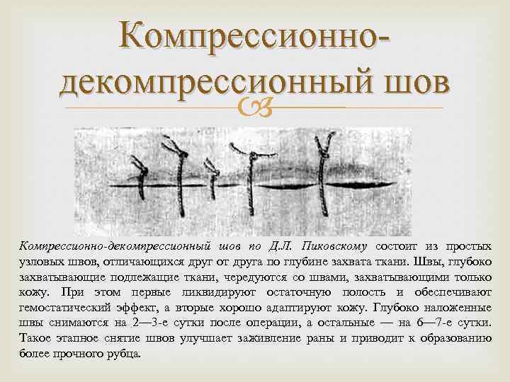 Компрессионнодекомпрессионный шов Компрессионно-декомпрессионный шов по Д. Л. Пиковскому состоит из простых узловых швов, отличающихся