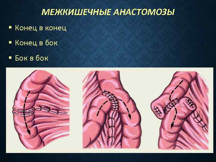 Техника конца. Кишечный анастомоз конец в бок. Тонкокишечный анастомоз конец в конец. Анастомоз кишки конец в бок.