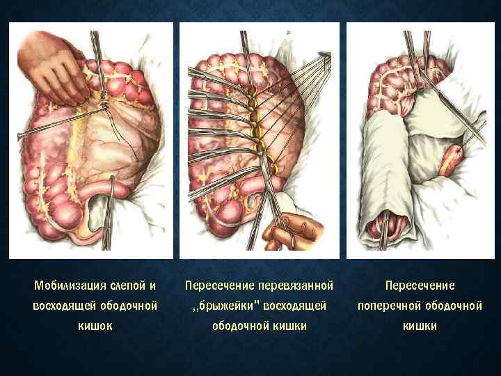 Мобилизация слепой и восходящей ободочной кишок Пересечение перевязанной „брыжейки" восходящей ободочной кишки Пересечение поперечной