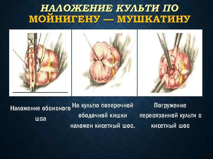 НАЛОЖЕНИЕ КУЛЬТИ ПО МОЙНИГЕНУ — МУШКАТИНУ Погружение Наложение обвивного На культю поперечной ободочной кишки