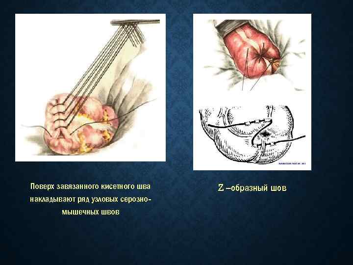 Поверх завязанного кисетного шва накладывают ряд узловых серозно мышечных швов Z –образный шов 