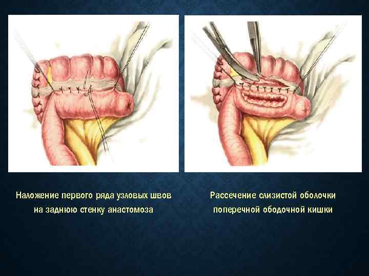 Наложение первого ряда узловых швов на заднюю стенку анастомоза Рассечение слизистой оболочки поперечной ободочной