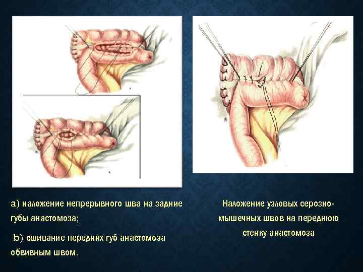 a) наложение непрерывного шва на задние губы анастомоза; b) сшивание передних губ анастомоза обвивным